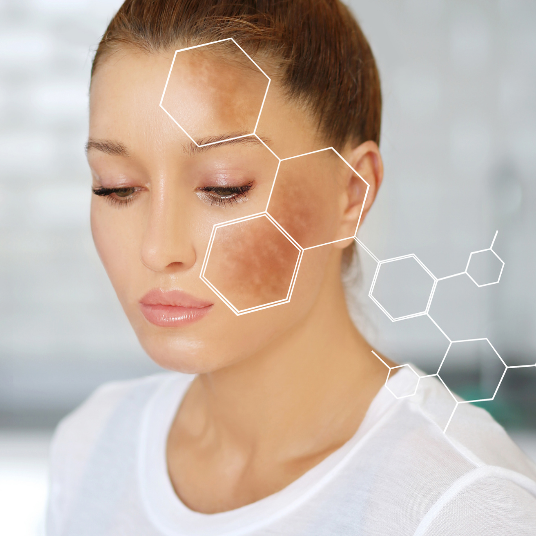 Dealing with Hyper-pigmentation in Sensitive Skin: Natural Remedies for Even-Toned Beauty.